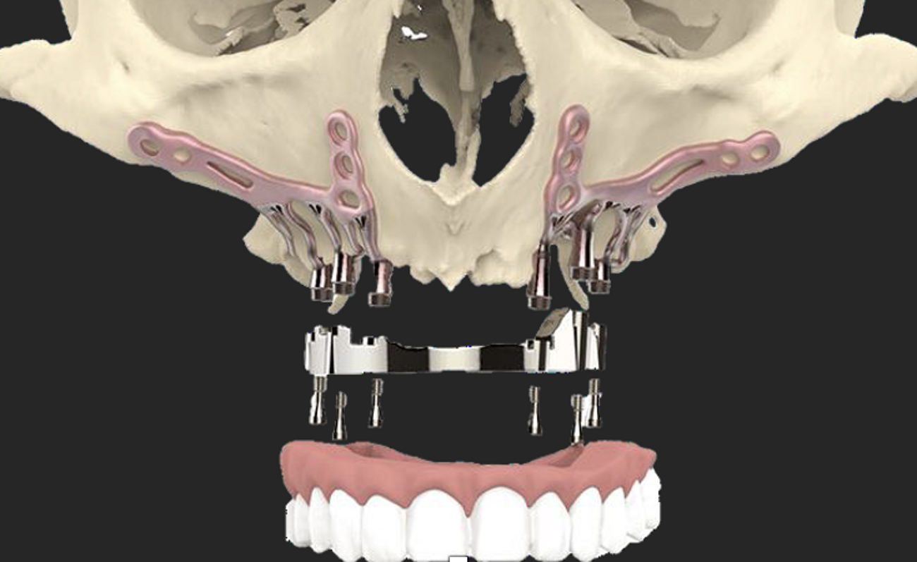 AMSubperiosteal All-on-Frame Implantoprosthodontics and  PS TMJ Replacement