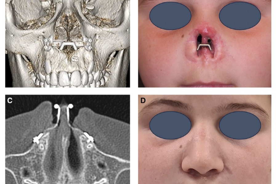 Pediatric nose reconstruction on PSI
