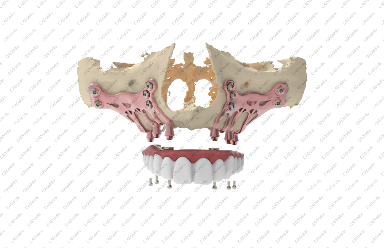 AMSJI®™, een implanto-prothetische constructie